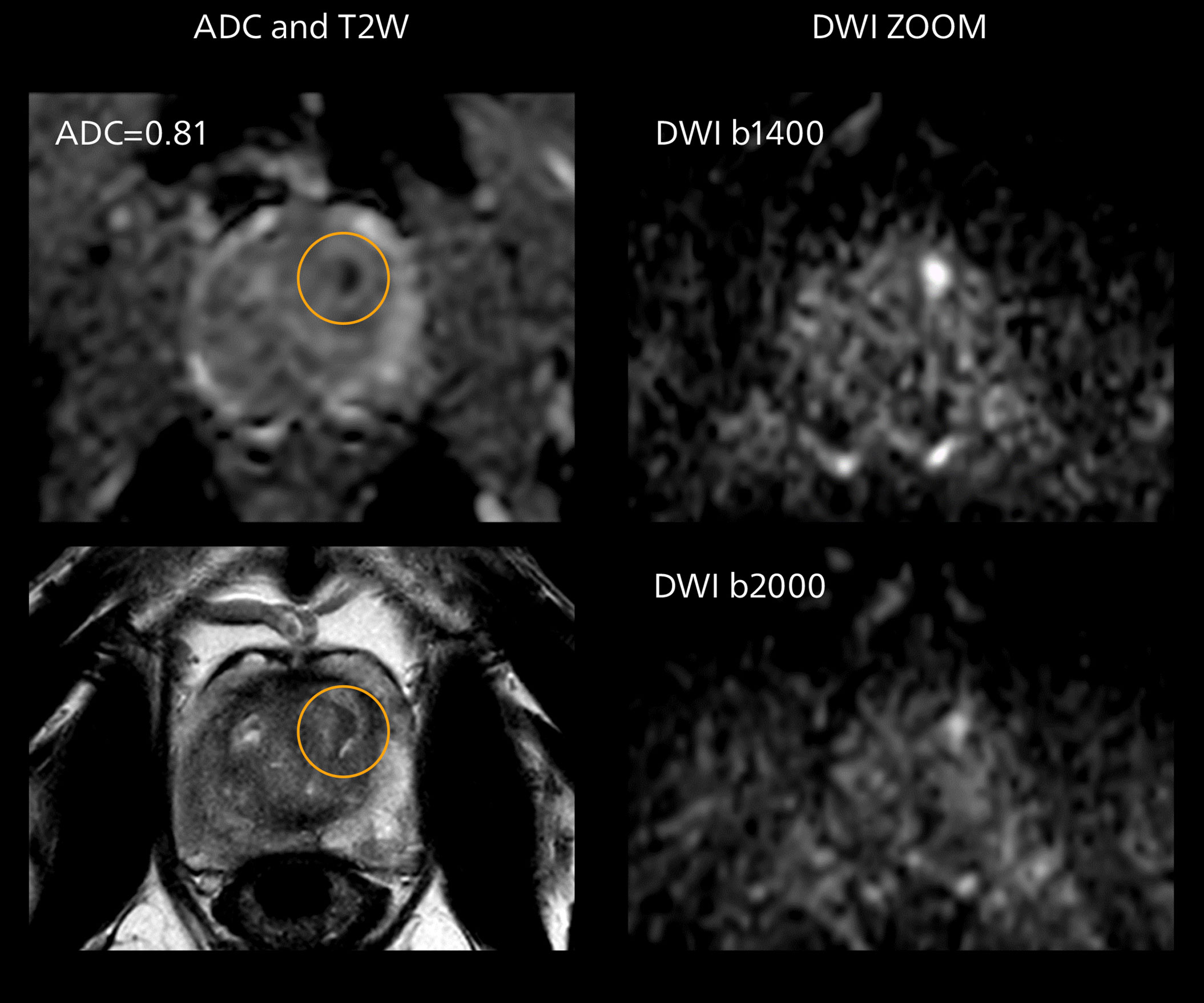 Prostate mri two