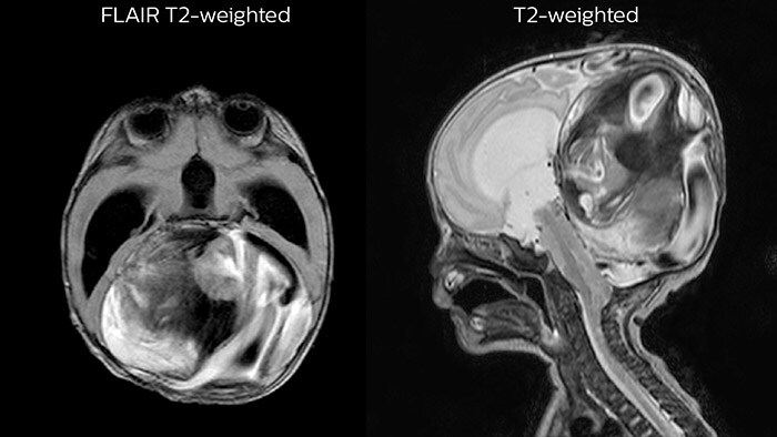 Dural sinus malformation