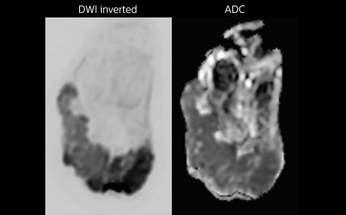 mDIXON TSE of ankle melanoma