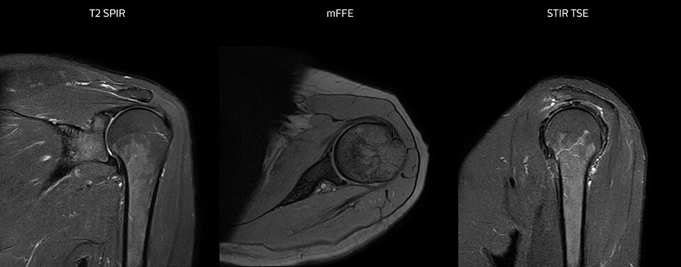 Shoulder MRI with high quality, large coverage