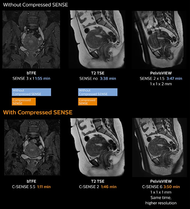 clinical image pelvis myoma compressed sense desktop