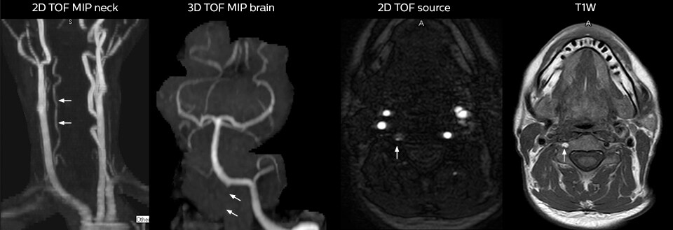 headneck mra in ed