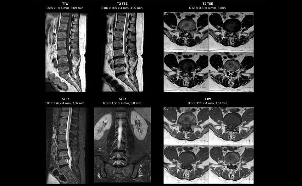 MRI of spondylosis in lumbar spine