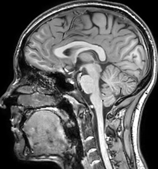 Myelin water imaging - T1 weighted