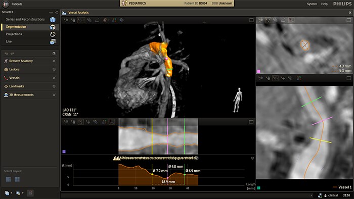 Automatic vessel analysis from rotational angiography