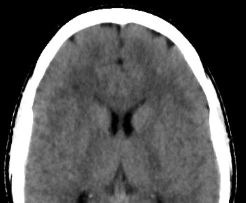 Ischaemic white matter disease, IMR vs MRI