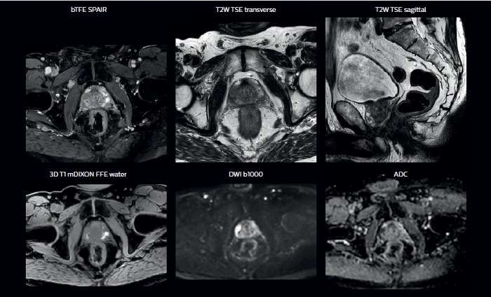 Approaches for including MRI in radiation therapy planning