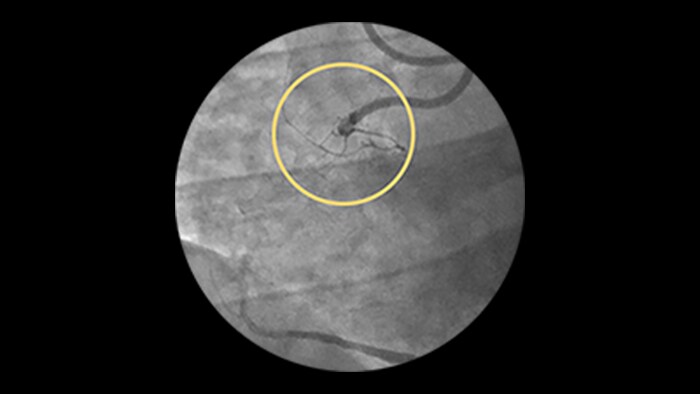 Chronic total occlusions