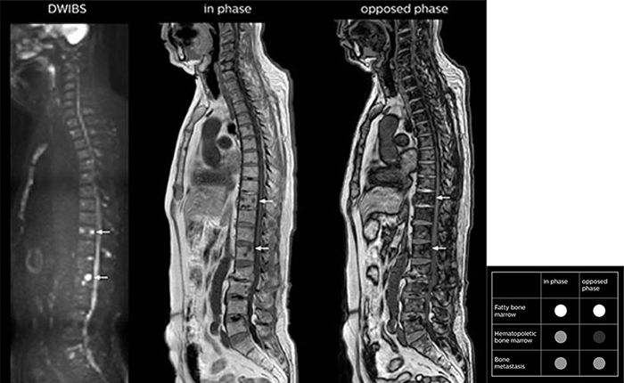 Whole body MRI X-ray