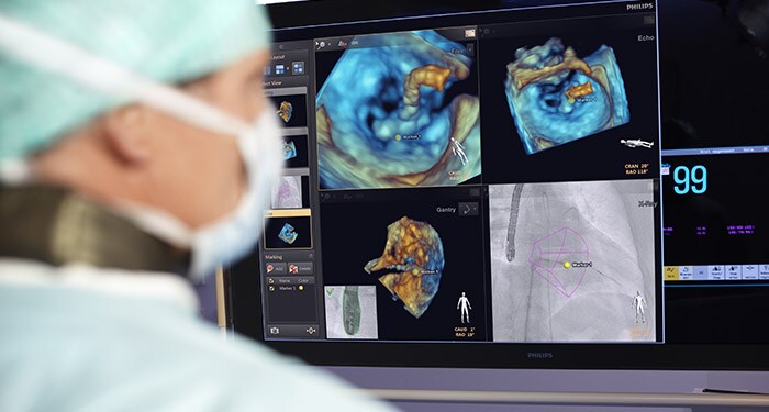 Treating structural heart disease with image-guided intervention | Philips